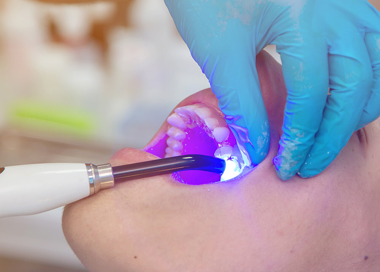 Füllungstherapie - Zahnfüllungen | Zahnärzte Bielefeld Dr. Höing & Dr. Mertens Zahnfüllungen für verlorene Zahnsubstanz - Zahnärzte Bielefeld Dr. Höing & Dr. Mertens