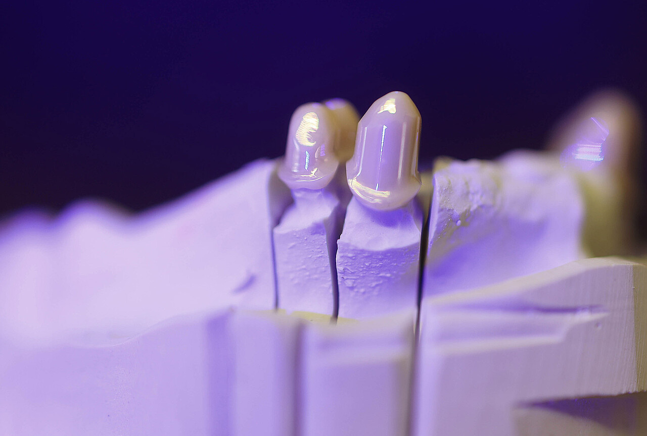 Hochwertiger Zahnersatz | Dental-Labor Bielefeld | Zahnärzte Bielefeld Dr. Höing + Dr. Mertens Hochwertiger Zahnersatz aus unserem angeschlossenen Dentallabor von erfahrenen Zahntechnikern. Zahnärzte Bielefeld Dr. Höing + Dr. Mertens