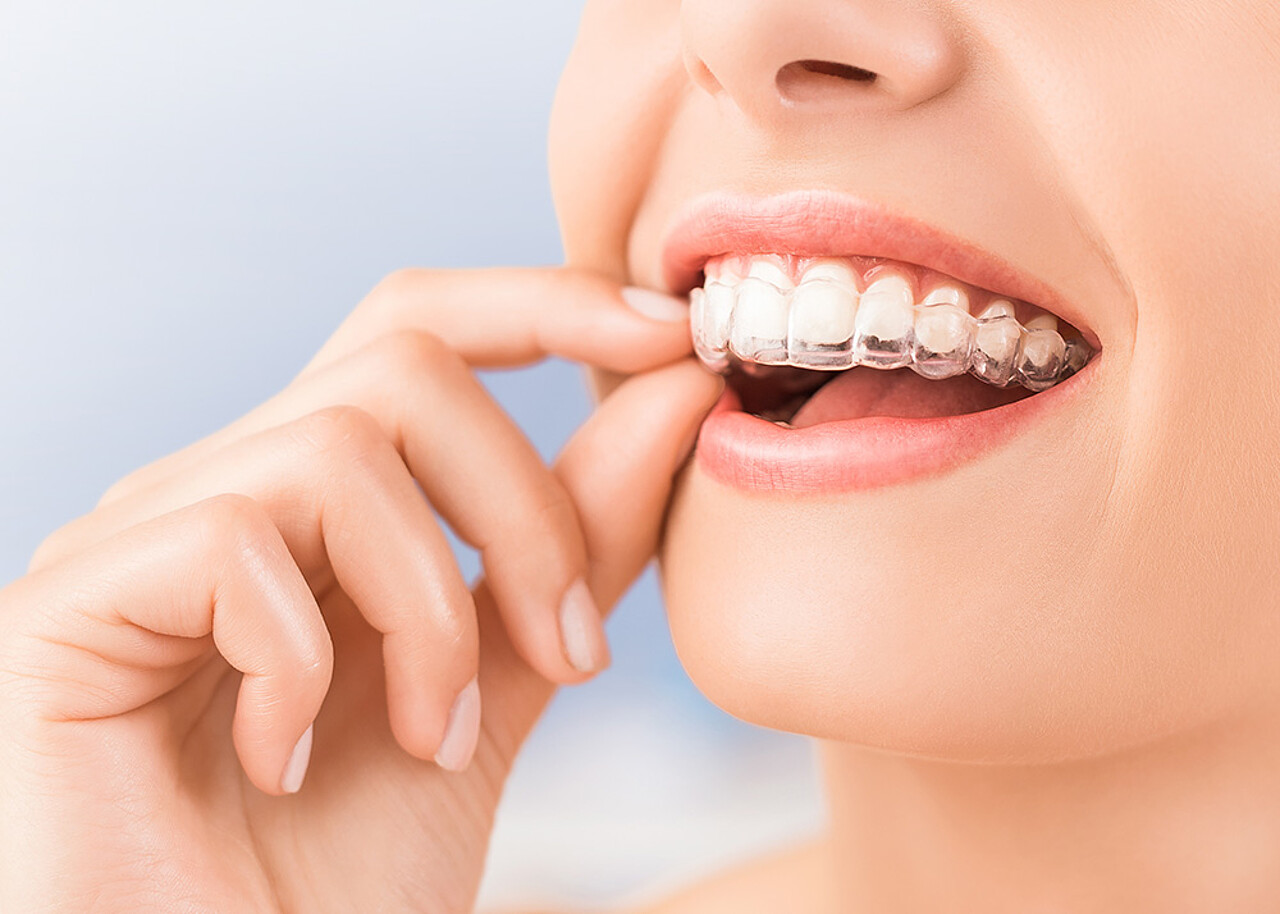 Zahnkorrekturen mit Schienen / Aligner-Therapie | Zahnärzte Bielefeld Dr. Höing & Dr. Mertens Zahnkorrekturen mit Schienen / Aligner-Therapie - Die komfortable Korrektur - Zahnärzte Bielefeld Dr. Höing & Dr. Mertens
